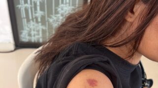 Inilah bukti fisik kekerasan yang dialami Elisabeth Erin. Erin kini melaporkan Ansi Moa dan Olivia Moa ke Polres Sikka. (nttkreatif.com/Mardat)